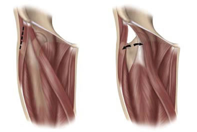 Diagram of Direct Anterior Approach