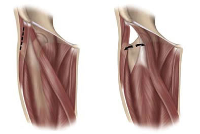 Diagram of Direct Anterior Approach
