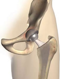 Diagram of traditional total hip replacement